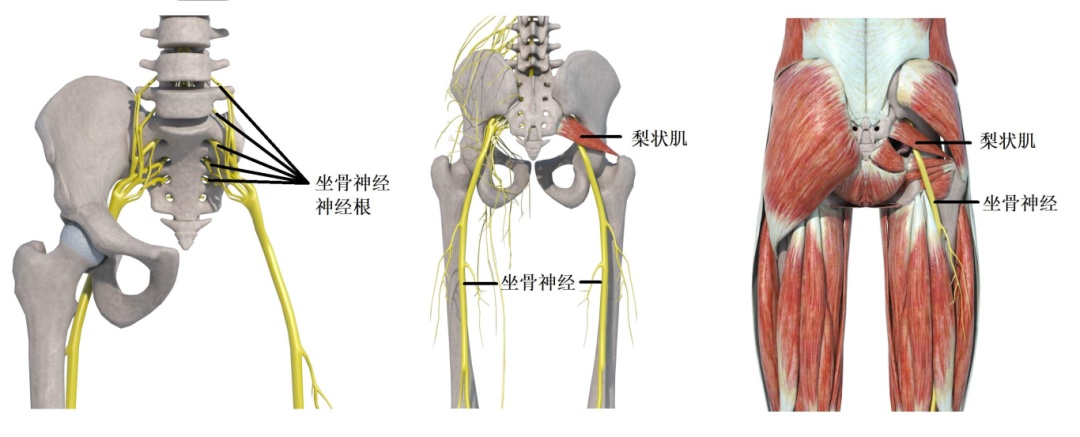 关注有一种腿痛叫梨状肌综合症