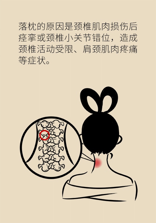 醒来脖子动不了落枕防不胜防4个妙招快速缓解