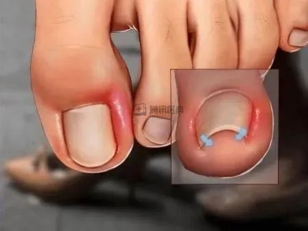 看着都疼拍下这张照片的医生感慨很多人不会剪指甲这些常见做法特别伤