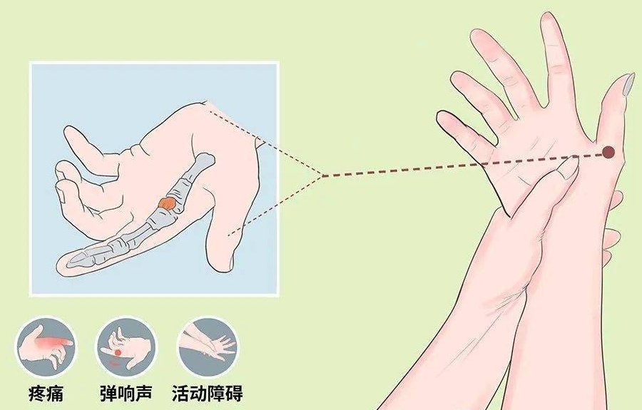 方法教你自测有无腱鞘炎:握拳尺偏试验(finkelstein征)将拇指置于掌心