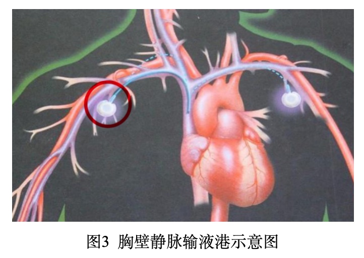 输液港植入位置图片图片