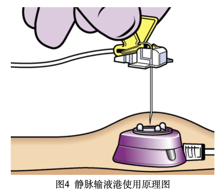 输液港组成图片