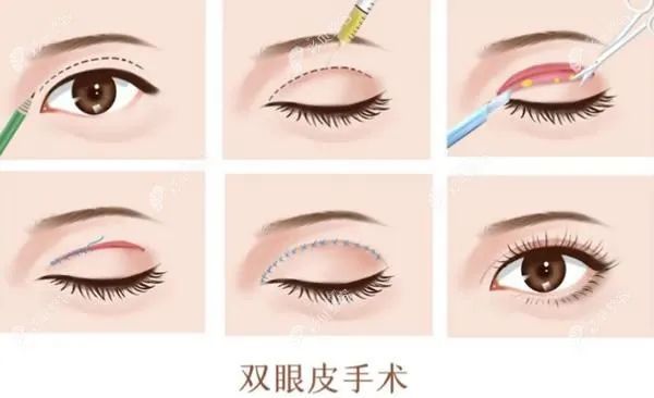 双眼皮手术方法选择_割完双眼皮注意事项_双眼皮手术适应症