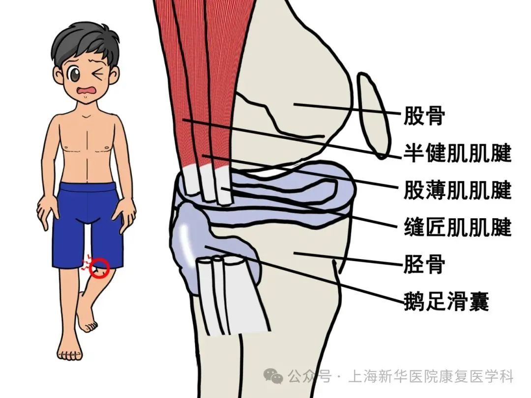 跑步不热身当心鹅足腱作祟膝盖痛