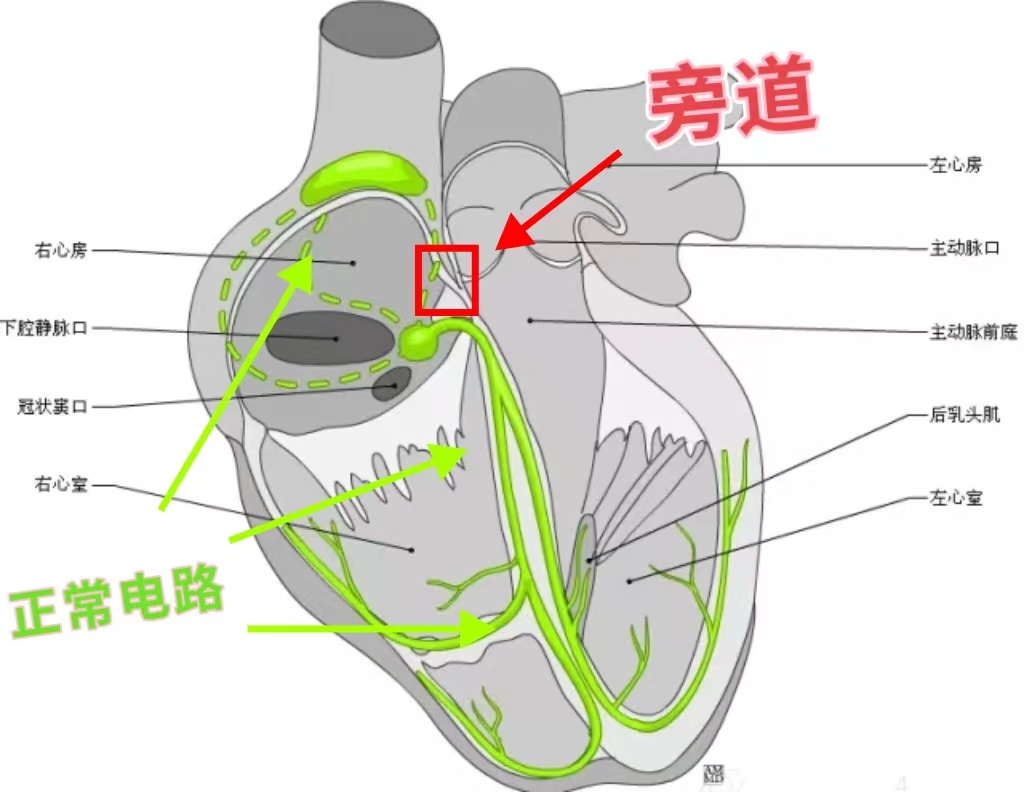 小彤被送入手术室,心内科电生理专家王宏伟副主任医师通过体表心电图