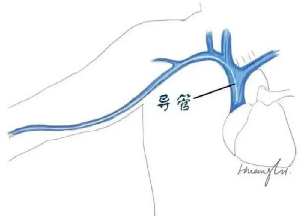 上腔静脉压迫图片