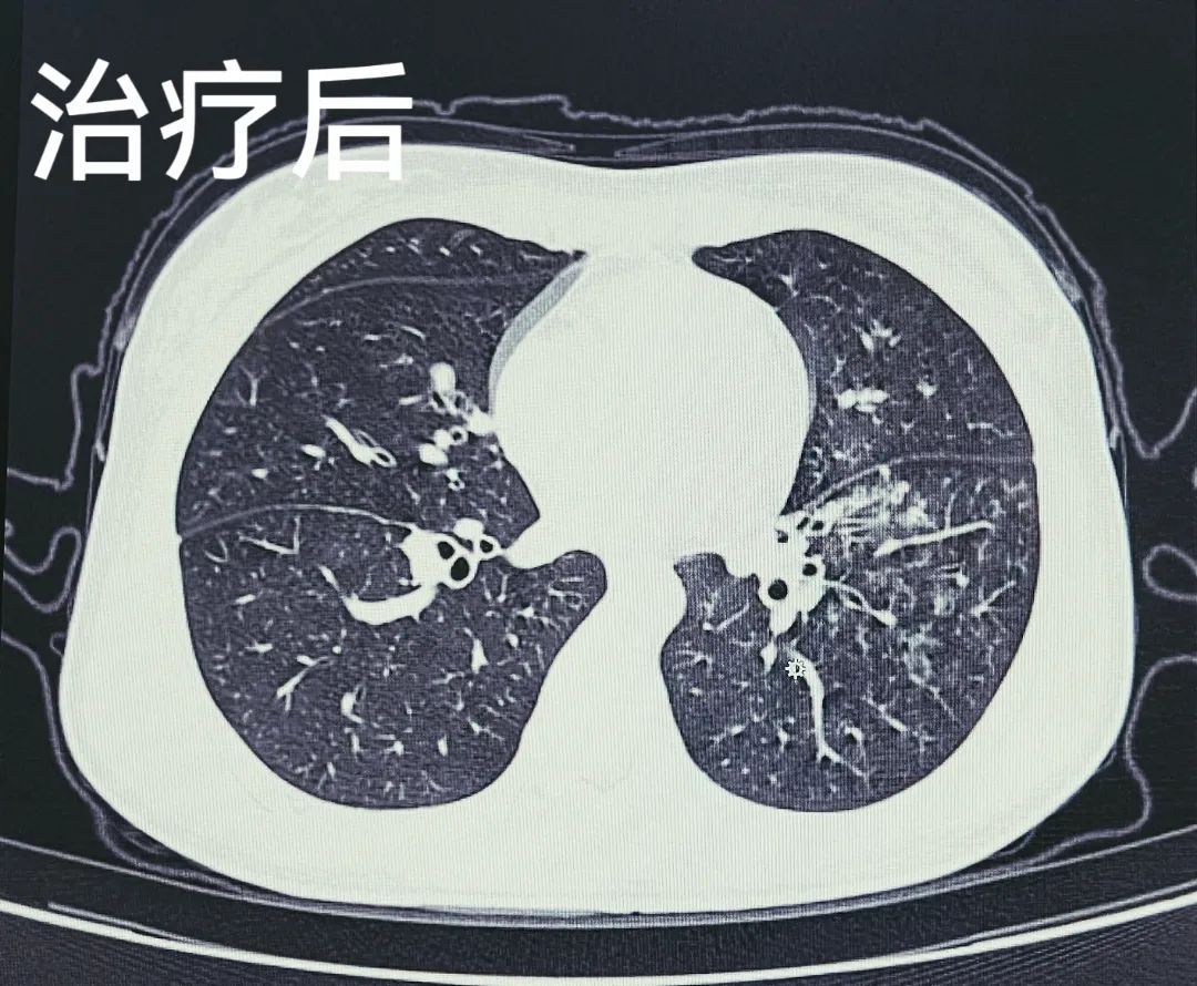 多学科联手方塔中医医院完成首例儿科纤维支气管镜治疗