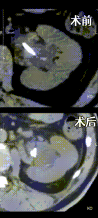 宝山区首例局麻下输尿管软镜钬激光碎石术成功实施