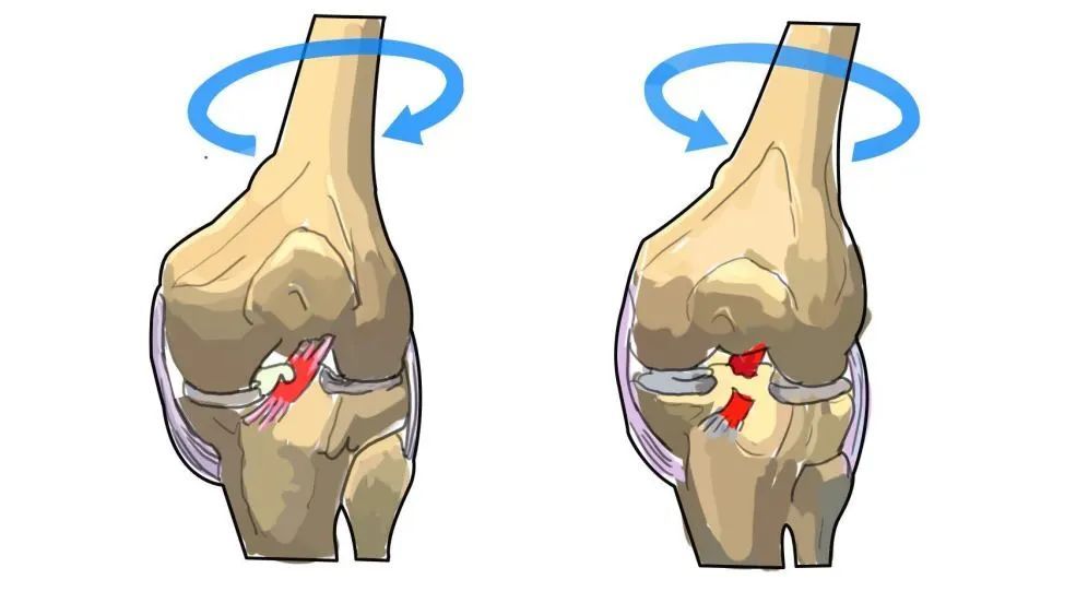 前十字交叉韧带撕裂图片