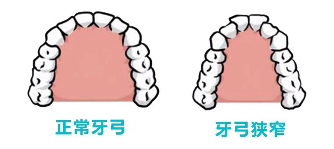 牙弓狭窄图片