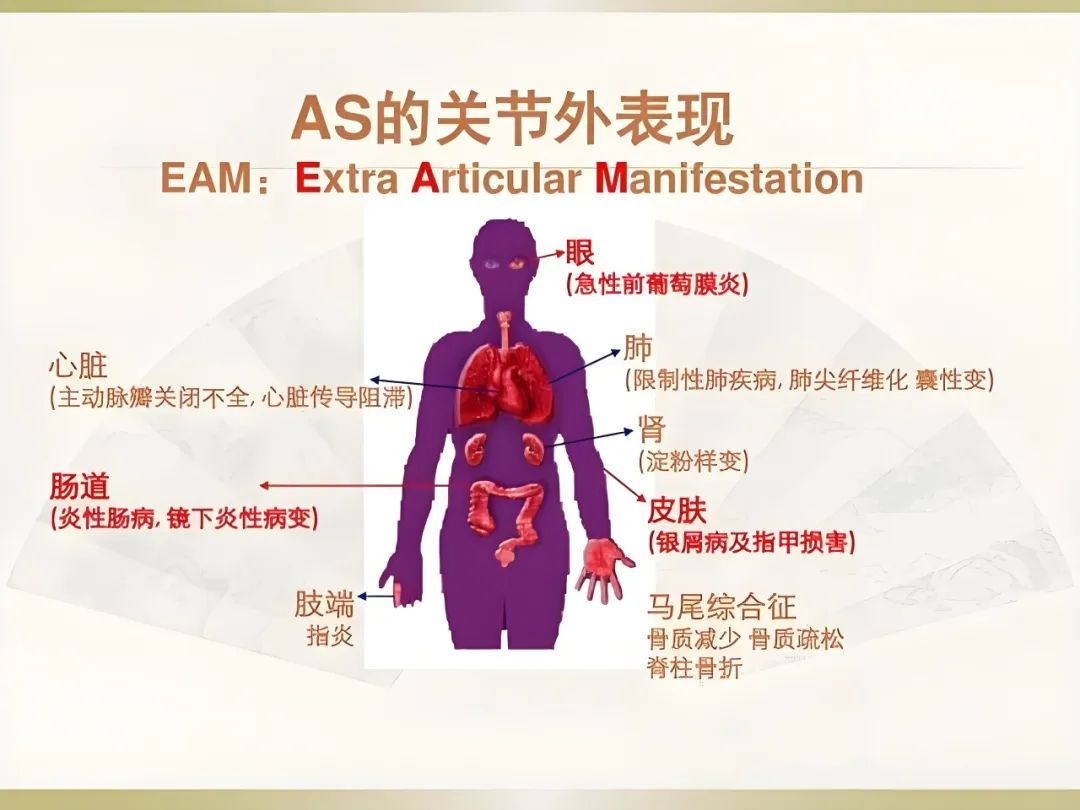 【科普先锋】了解强直性脊柱炎,远离病痛拥抱健康