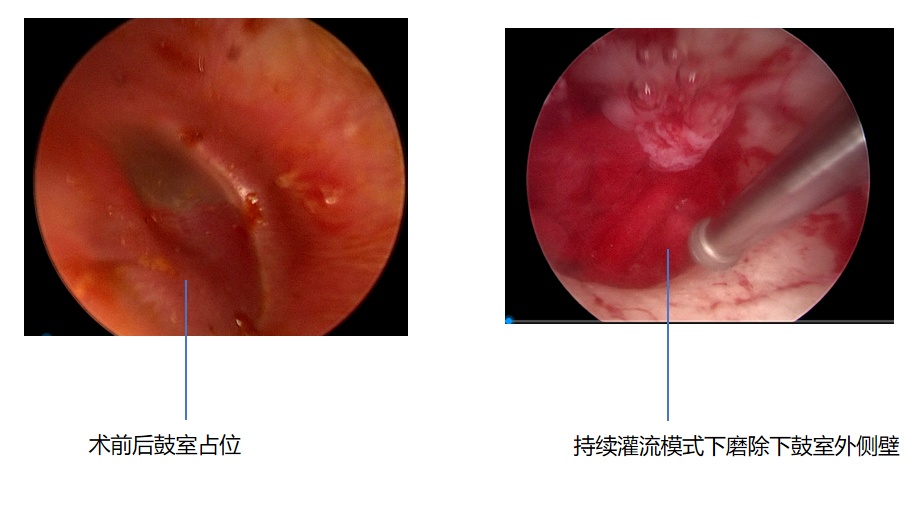 耳朵肉芽切除手术图解图片