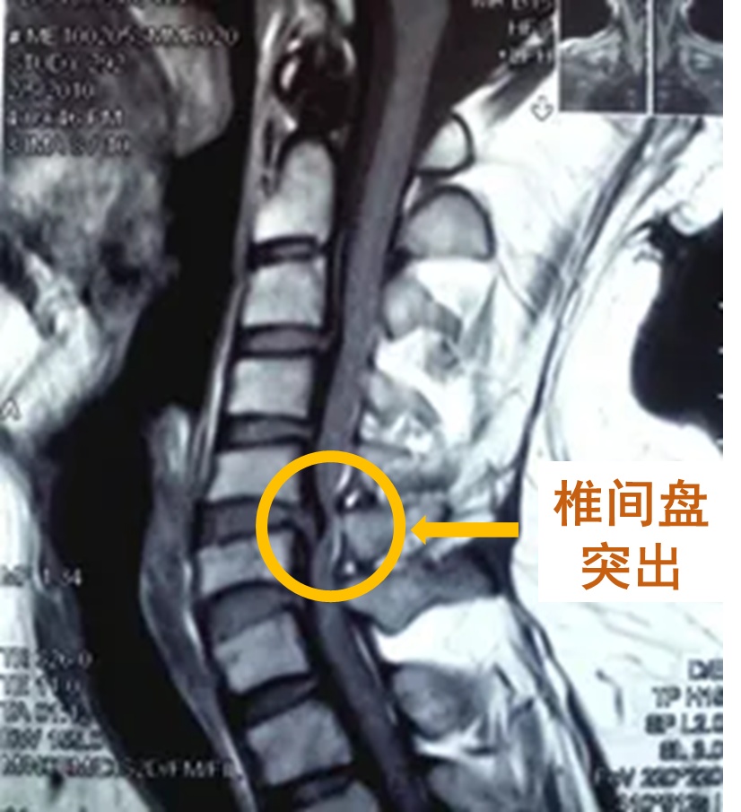 结果显示两组患者之间的颈椎脱位,椎间盘退行性变,脊髓压迫,椎动脉