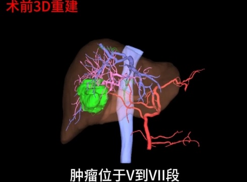 别慌!医生用一根针,肝血管瘤消失了