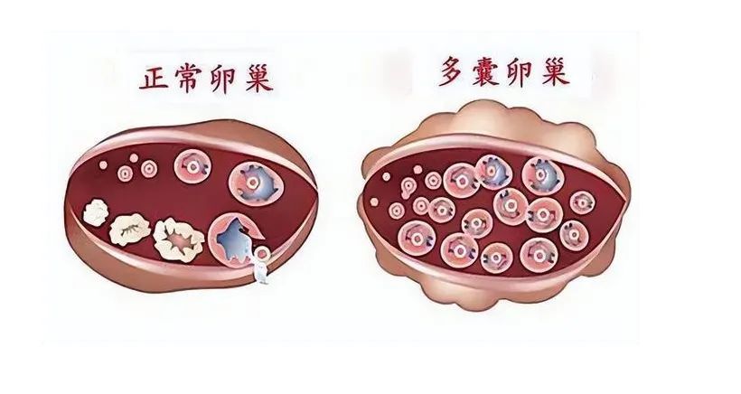 多囊是什么图片