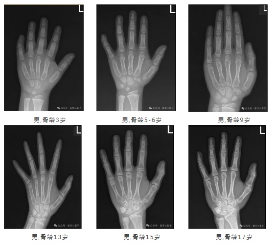 骨龄对照图最新图片