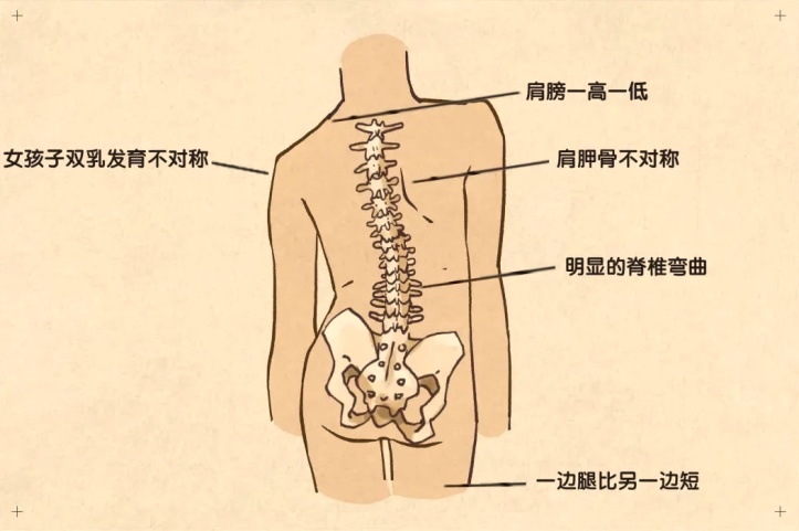 肩胛骨一高一低图片图片