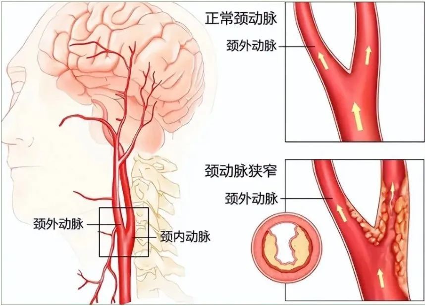 颈动脉管外口的位置图片