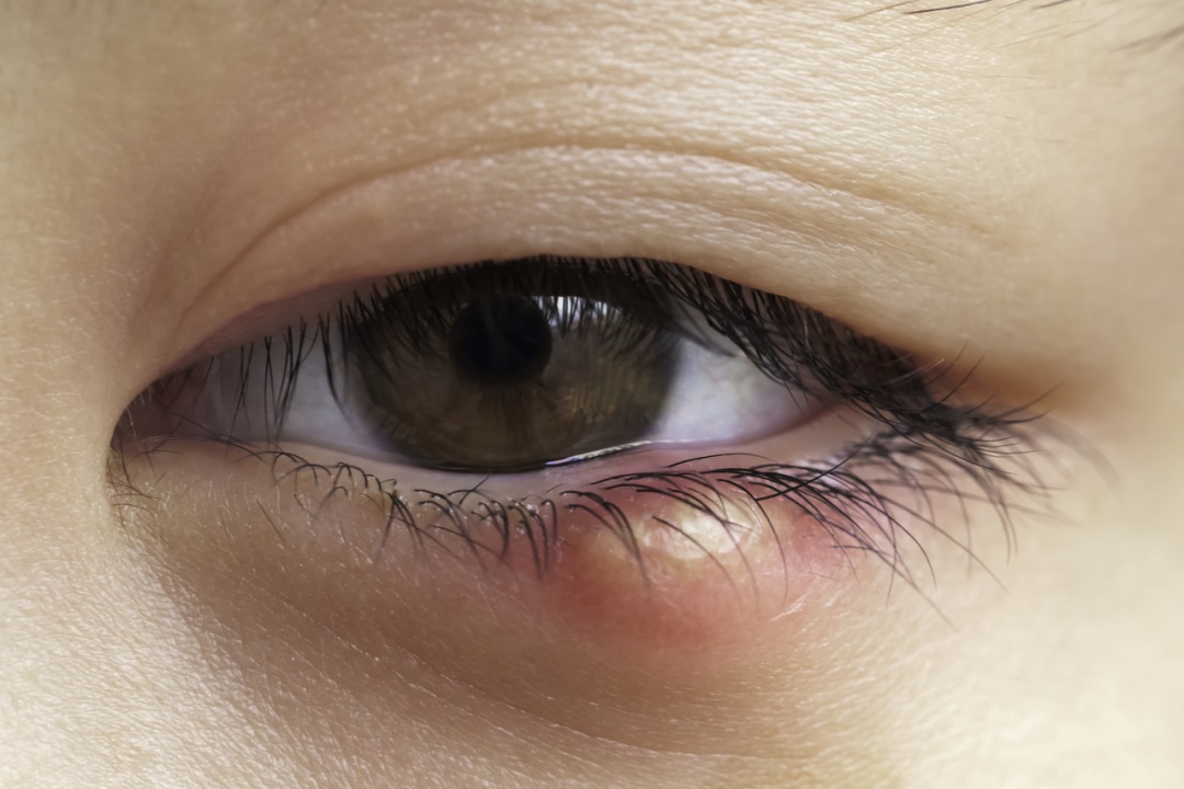 【科普先锋】夏日里的小烦恼——眼睛上也会长"青春痘"?