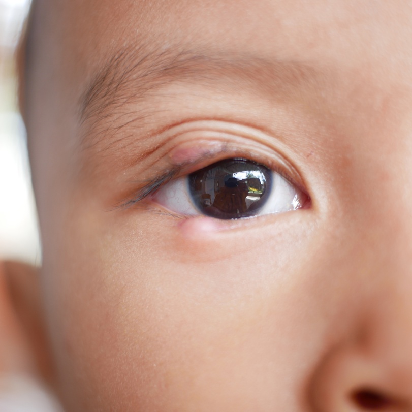 麦粒肿,俗称"针眼,偷针眼",医学上被称为为