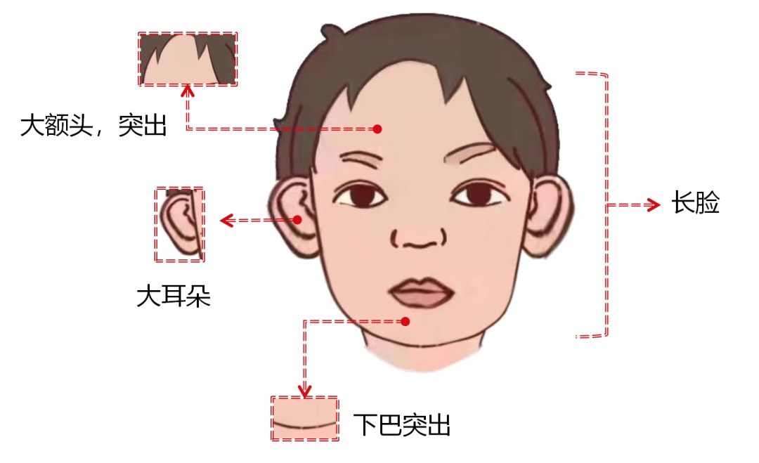 脆性x综合征(fragile x syndrome,fxs)是一种由fmr1基因全突变或功能