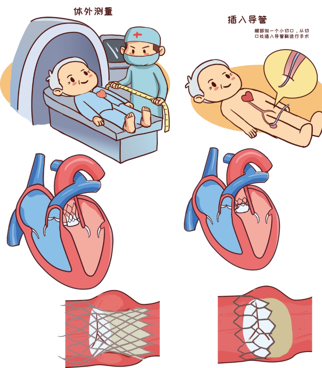 心脏介入手术漫画图片