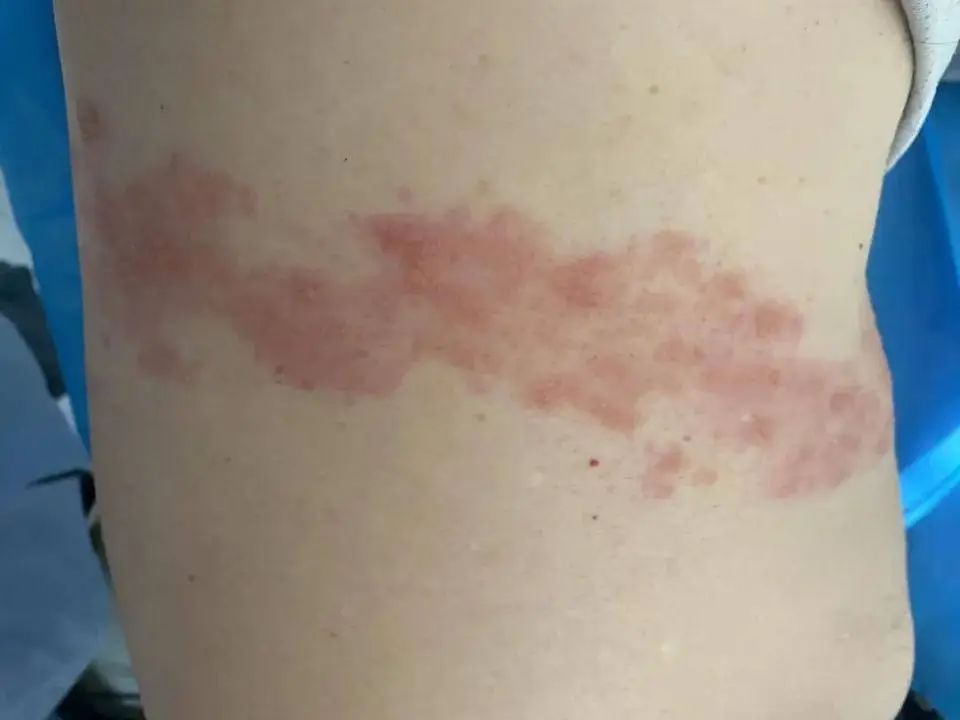 你知道有一种皮肤病,有些人皮疹消退后是什么病吗?"蛇胆疮""蛇