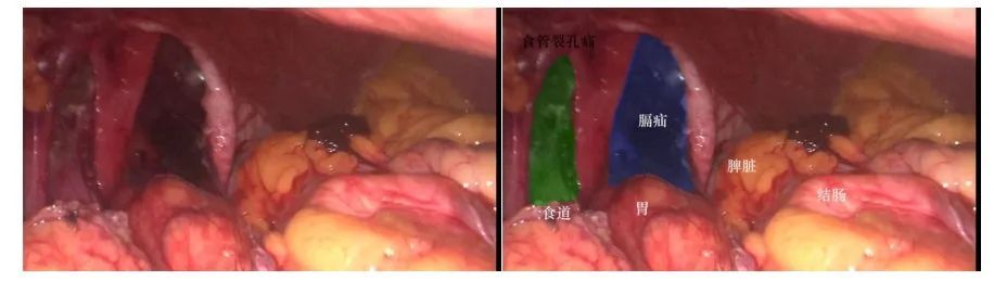 反酸、烧心、腹痛，原是胃肠“乱入”胸腔！(图3)