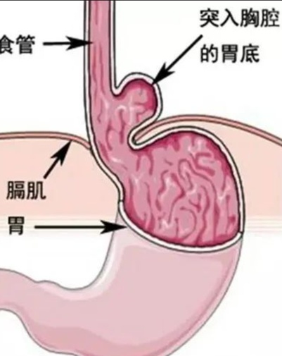 反酸、烧心、腹痛，原是胃肠“乱入”胸腔！(图1)